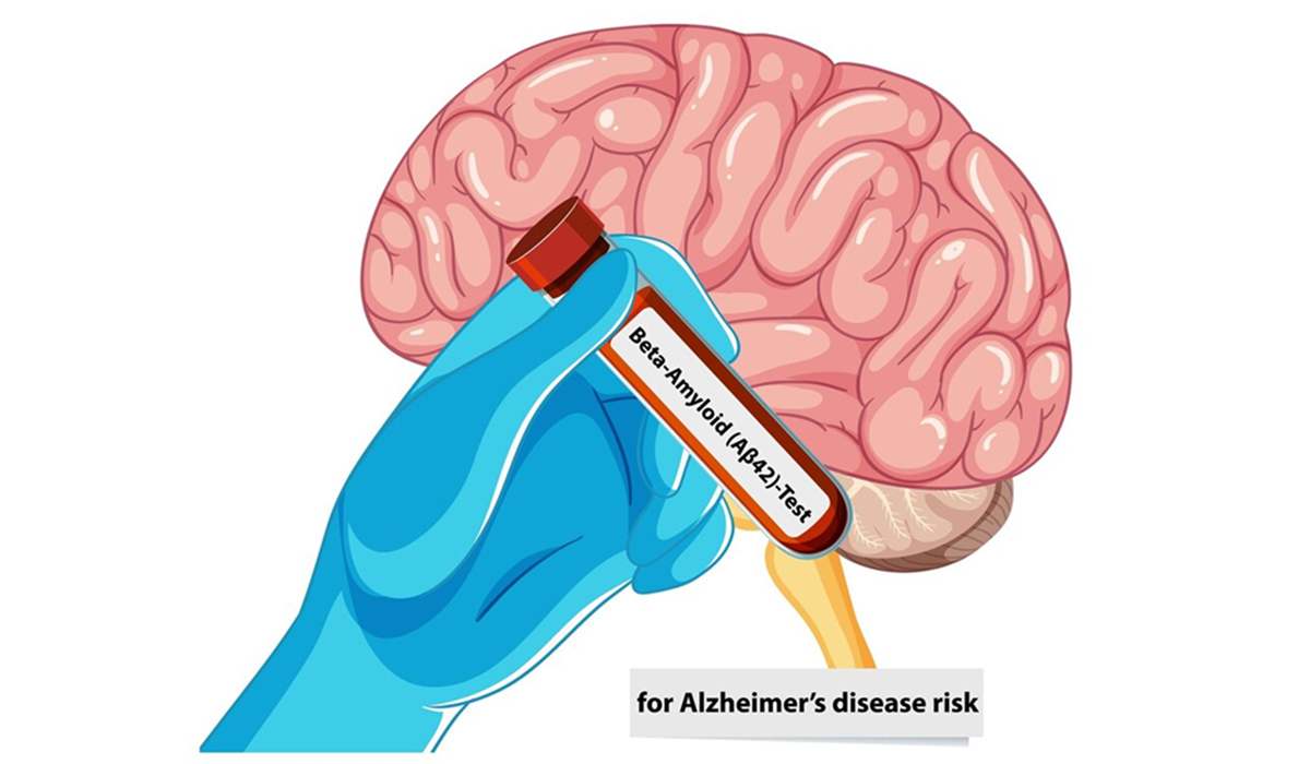 Penelitian Baru Penghapusan Plak Beta Amiloid Bisa Menunda Alzheimer